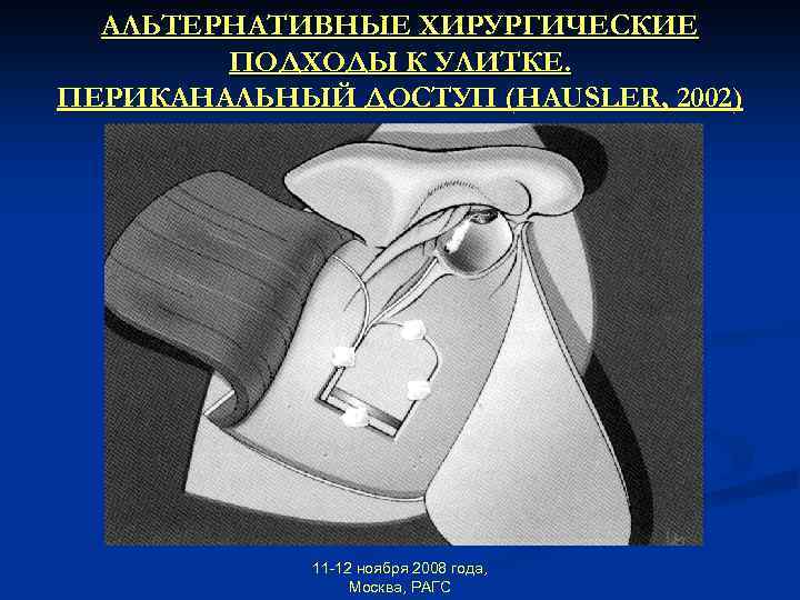 АЛЬТЕРНАТИВНЫЕ ХИРУРГИЧЕСКИЕ ПОДХОДЫ К УЛИТКЕ. ПЕРИКАНАЛЬНЫЙ ДОСТУП (HAUSLER, 2002) 11 -12 ноября 2008 года,