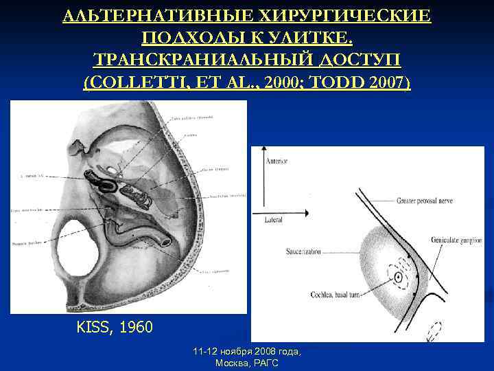 АЛЬТЕРНАТИВНЫЕ ХИРУРГИЧЕСКИЕ ПОДХОДЫ К УЛИТКЕ. ТРАНСКРАНИАЛЬНЫЙ ДОСТУП (COLLETTI, ET AL. , 2000; TODD 2007)