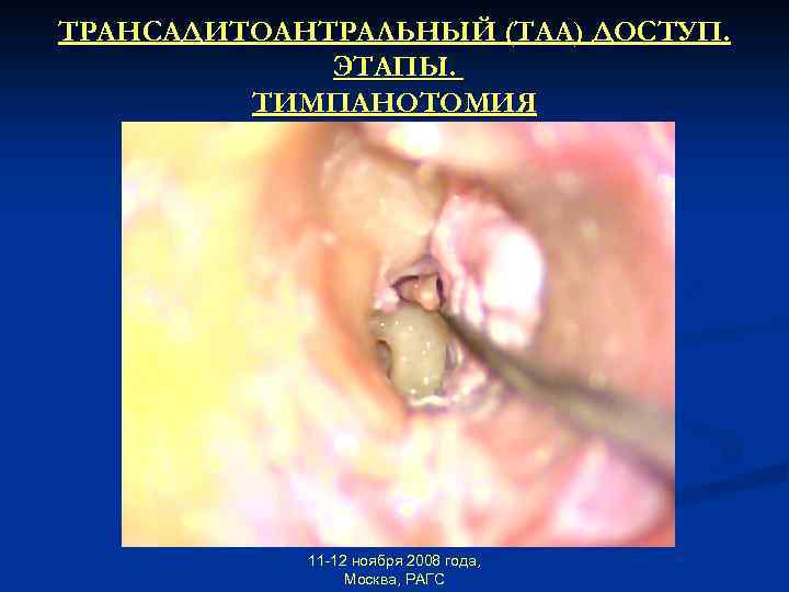 ТРАНСАДИТОАНТРАЛЬНЫЙ (ТАА) ДОСТУП. ЭТАПЫ. ТИМПАНОТОМИЯ 11 -12 ноября 2008 года, Москва, РАГС 