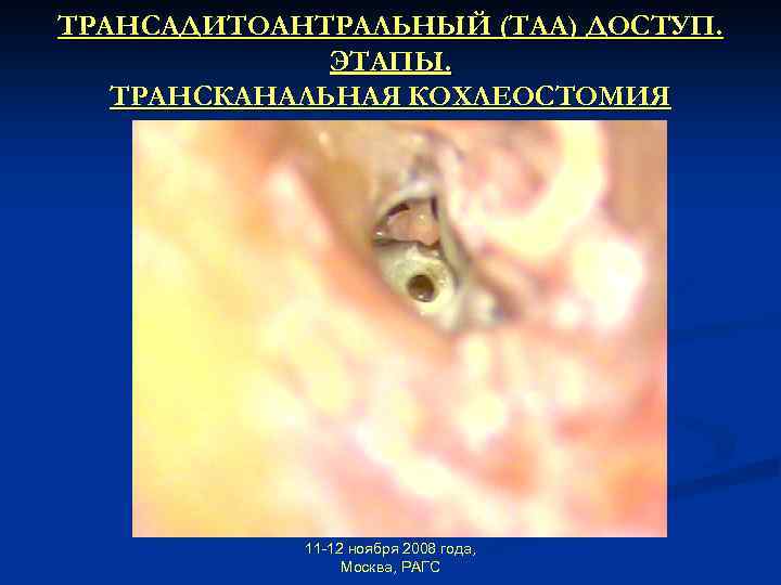 ТРАНСАДИТОАНТРАЛЬНЫЙ (ТАА) ДОСТУП. ЭТАПЫ. ТРАНСКАНАЛЬНАЯ КОХЛЕОСТОМИЯ 11 -12 ноября 2008 года, Москва, РАГС 