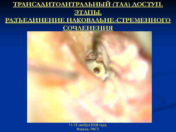 ТРАНСАДИТОАНТРАЛЬНЫЙ (ТАА) ДОСТУП. ЭТАПЫ. РАЗЪЕДИНЕНИЕ НАКОВАЛЬНЕ-СТРЕМЕННОГО СОЧЛЕНЕНИЯ 11 -12 ноября 2008 года, Москва, РАГС