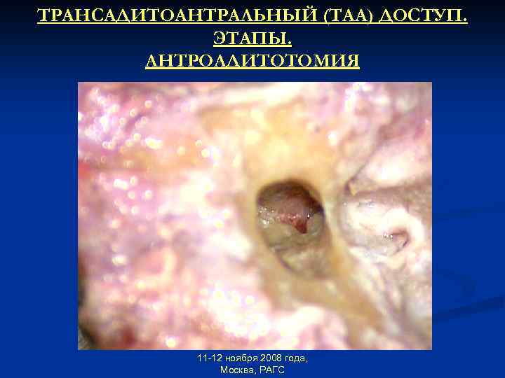 ТРАНСАДИТОАНТРАЛЬНЫЙ (ТАА) ДОСТУП. ЭТАПЫ. АНТРОАДИТОТОМИЯ 11 -12 ноября 2008 года, Москва, РАГС 
