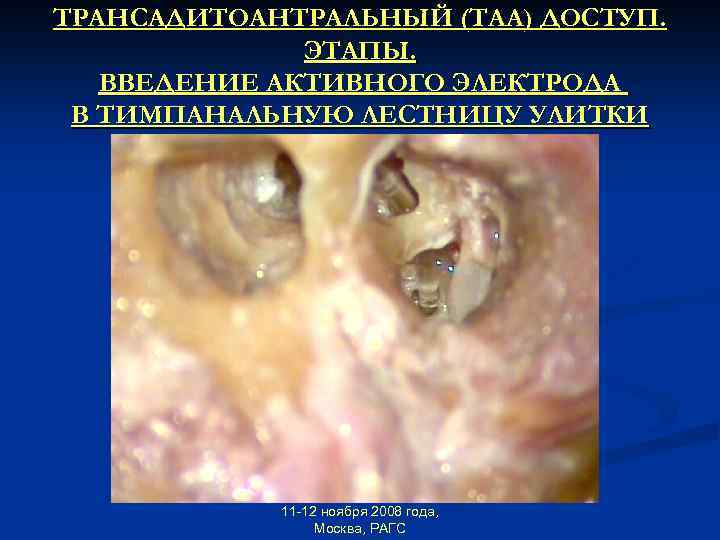 ТРАНСАДИТОАНТРАЛЬНЫЙ (ТАА) ДОСТУП. ЭТАПЫ. ВВЕДЕНИЕ АКТИВНОГО ЭЛЕКТРОДА В ТИМПАНАЛЬНУЮ ЛЕСТНИЦУ УЛИТКИ 11 -12 ноября