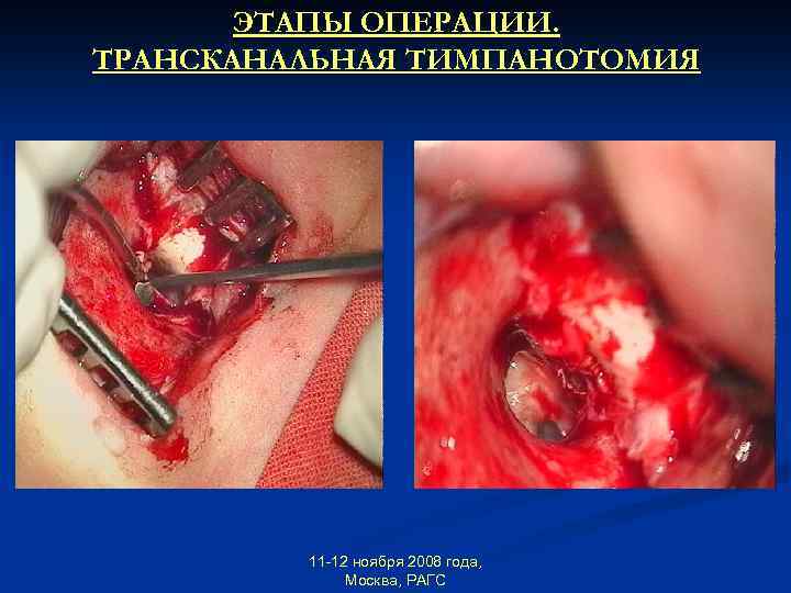 ЭТАПЫ ОПЕРАЦИИ. ТРАНСКАНАЛЬНАЯ ТИМПАНОТОМИЯ 11 -12 ноября 2008 года, Москва, РАГС 