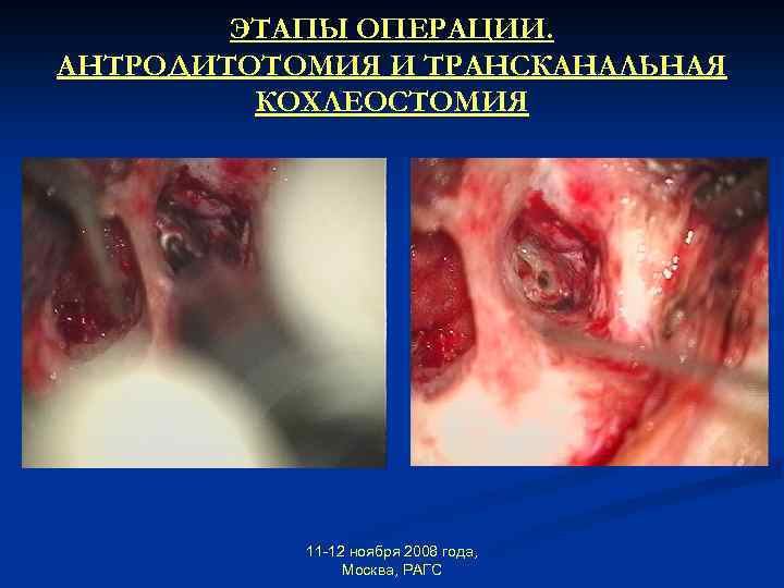 ЭТАПЫ ОПЕРАЦИИ. АНТРОДИТОТОМИЯ И ТРАНСКАНАЛЬНАЯ КОХЛЕОСТОМИЯ 11 -12 ноября 2008 года, Москва, РАГС 