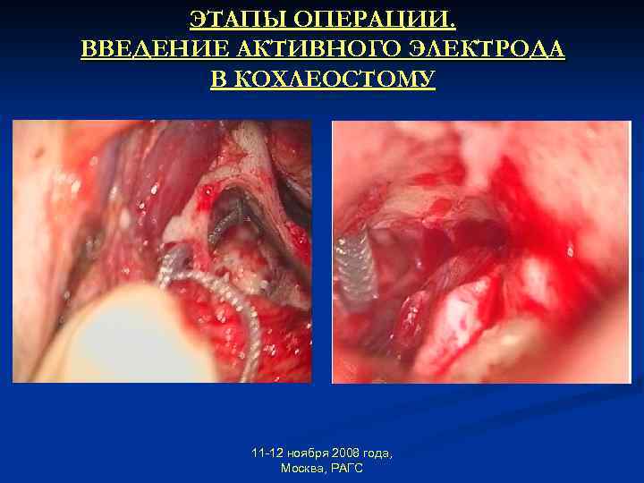 ЭТАПЫ ОПЕРАЦИИ. ВВЕДЕНИЕ АКТИВНОГО ЭЛЕКТРОДА В КОХЛЕОСТОМУ 11 -12 ноября 2008 года, Москва, РАГС