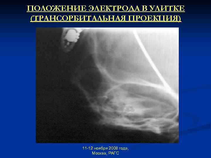 ПОЛОЖЕНИЕ ЭЛЕКТРОДА В УЛИТКЕ (ТРАНСОРБИТАЛЬНАЯ ПРОЕКЦИЯ) 11 -12 ноября 2008 года, Москва, РАГС 