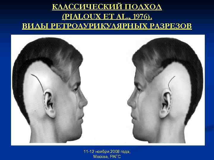 КЛАССИЧЕСКИЙ ПОДХОД (PIALOUX ET AL. , 1976). ВИДЫ РЕТРОАУРИКУЛЯРНЫХ РАЗРЕЗОВ 11 -12 ноября 2008