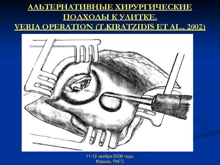 АЛЬТЕРНАТИВНЫЕ ХИРУРГИЧЕСКИЕ ПОДХОДЫ К УЛИТКЕ. VERIA OPERATION (T. KIRATZIDIS ET AL. , 2002) 11