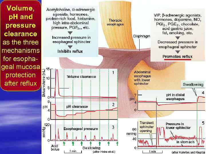 Volume, p. H and pressure clearance as the three mechanisms for esophageal mucosa protection