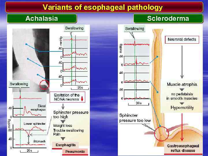 Variants of esophageal pathology Achalasia Scleroderma 