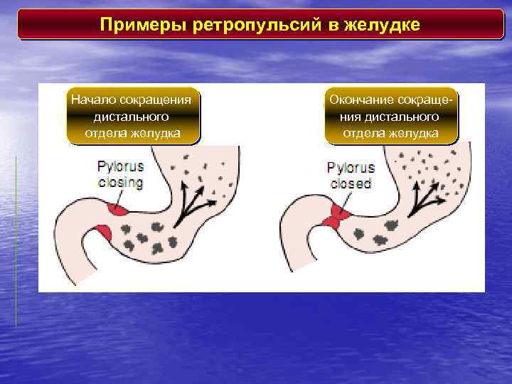 Примеры ретропульсий в желудке Начало сокращения дистального отдела желудка Окончание сокращения дистального отдела желудка