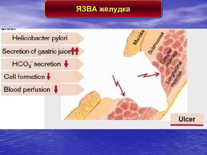 ЯЗВА желудка 