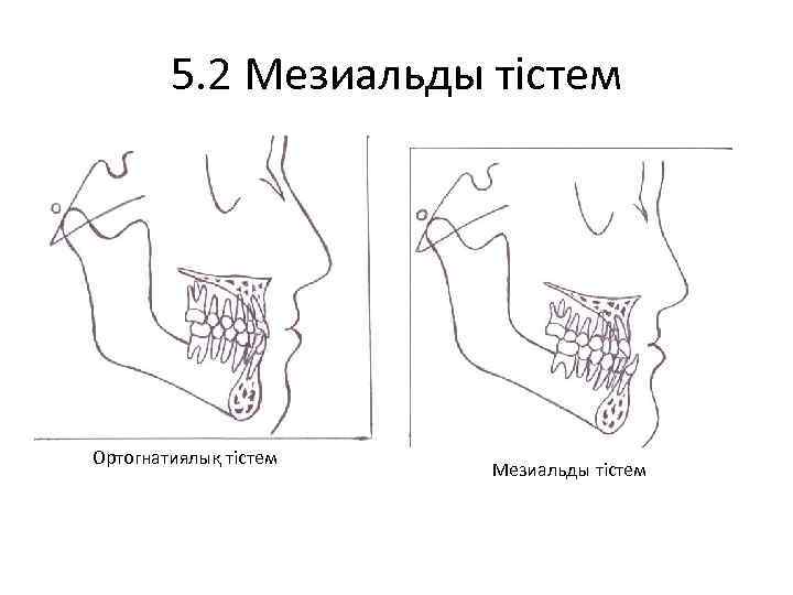 5. 2 Мезиальды тістем Ортогнатиялық тістем Мезиальды тістем 