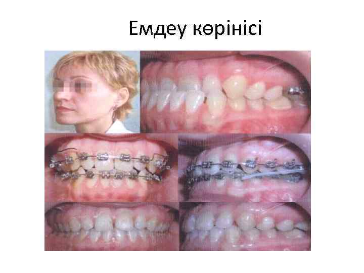 Емдеу көрінісі 