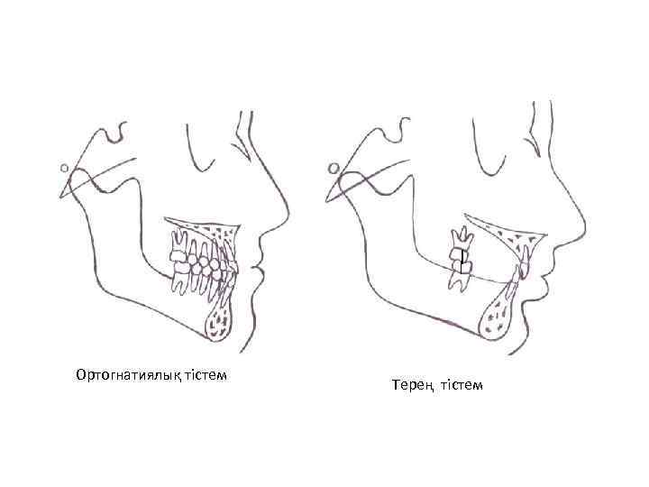 Ортогнатиялық тістем Терең тістем 