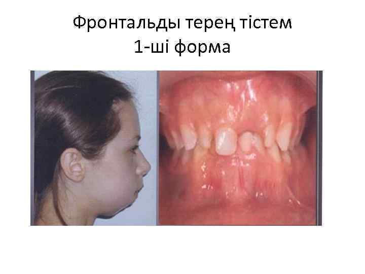 Фронтальды терең тістем 1 -ші форма 