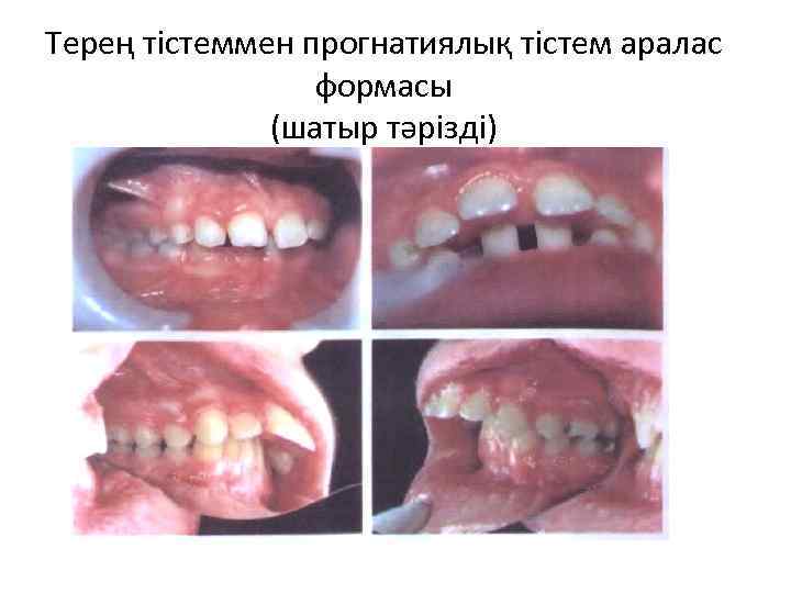 Терең тістеммен прогнатиялық тістем аралас формасы (шатыр тәрізді) 