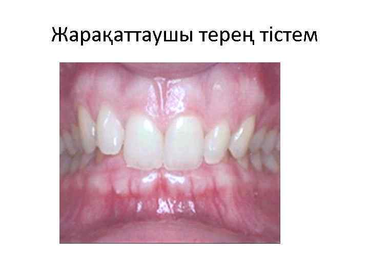 Жарақаттаушы терең тістем 