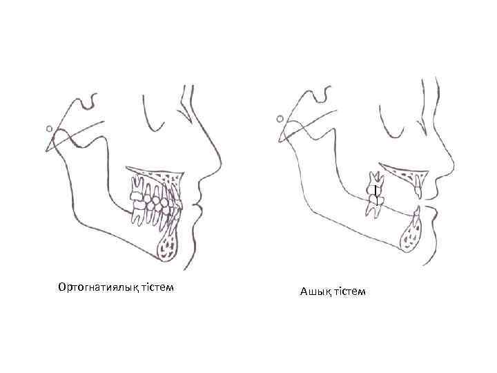Ортогнатиялық тістем Ашық тістем 
