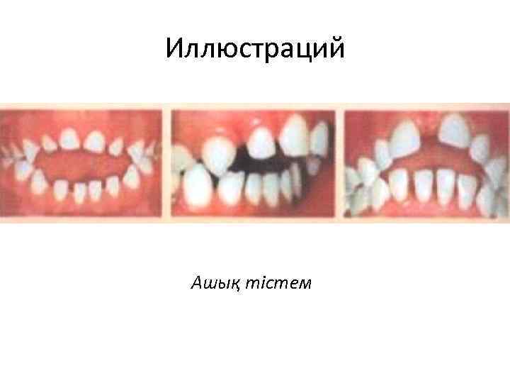 Иллюстраций Ашық тістем 