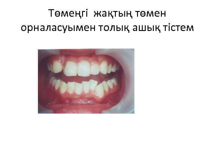 Төмеңгі жақтың төмен орналасуымен толық ашық тістем 