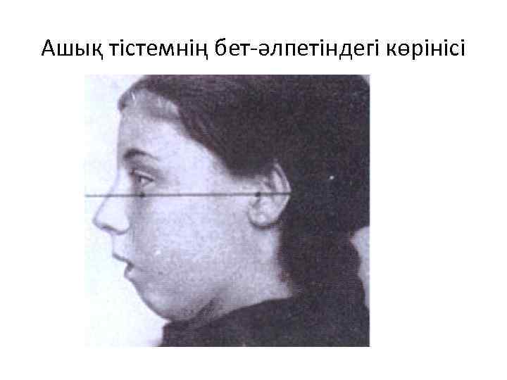 Ашық тістемнің бет-әлпетіндегі көрінісі 