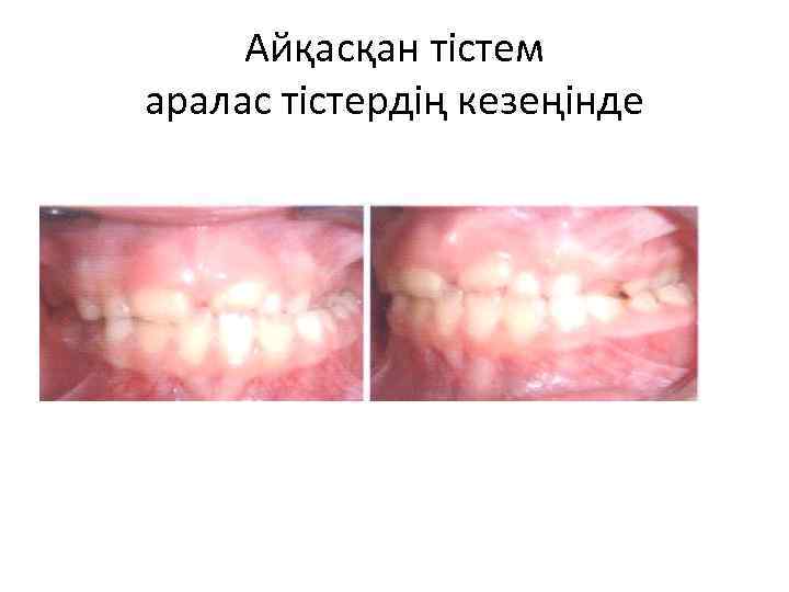 Айқасқан тістем аралас тістердің кезеңінде 