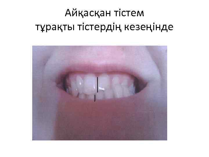 Айқасқан тістем тұрақты тістердің кезеңінде 