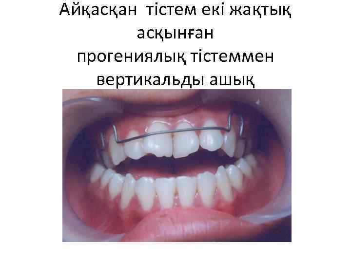 Айқасқан тістем екі жақтық асқынған прогениялық тістеммен вертикальды ашық 