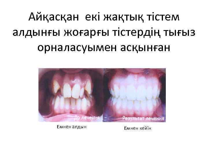 Айқасқан екі жақтық тістем алдынғы жоғарғы тістердің тығыз орналасуымен асқынған Емнен алдын Емнен кейін