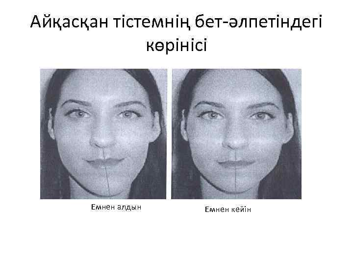 Айқасқан тістемнің бет-әлпетіндегі көрінісі Емнен алдын Емнен кейін 