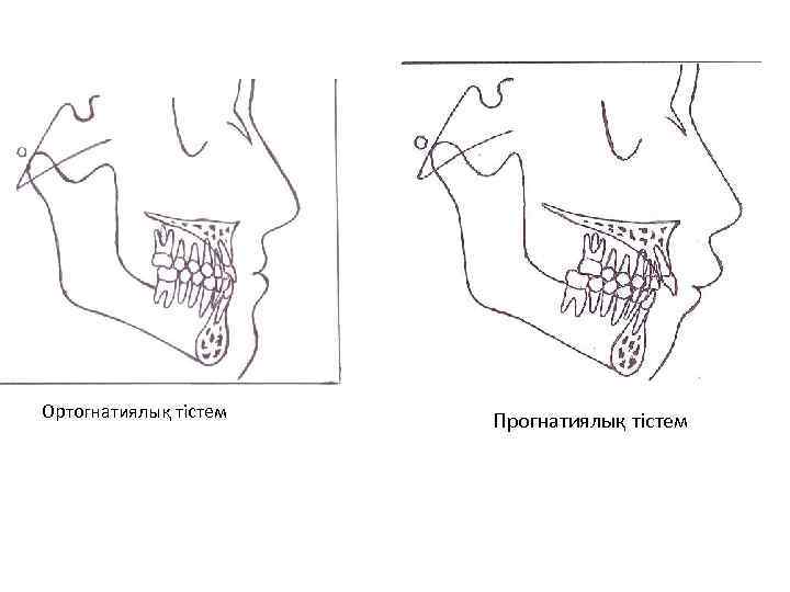 Ортогнатиялық тістем Прогнатиялық тістем 