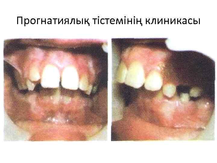 Прогнатиялық тістемінің клиникасы 