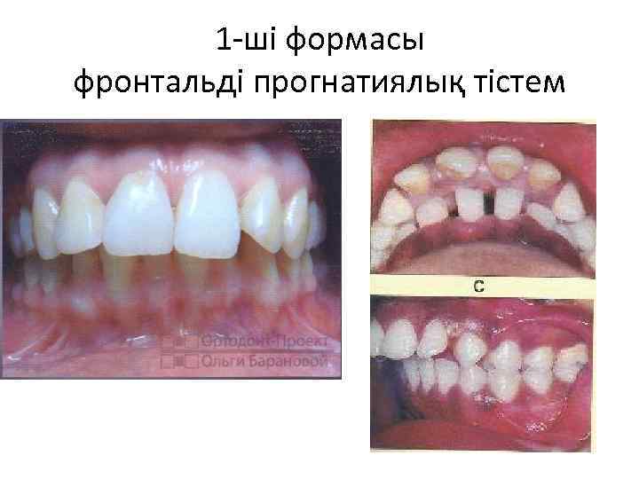 1 -ші формасы фронтальді прогнатиялық тістем 
