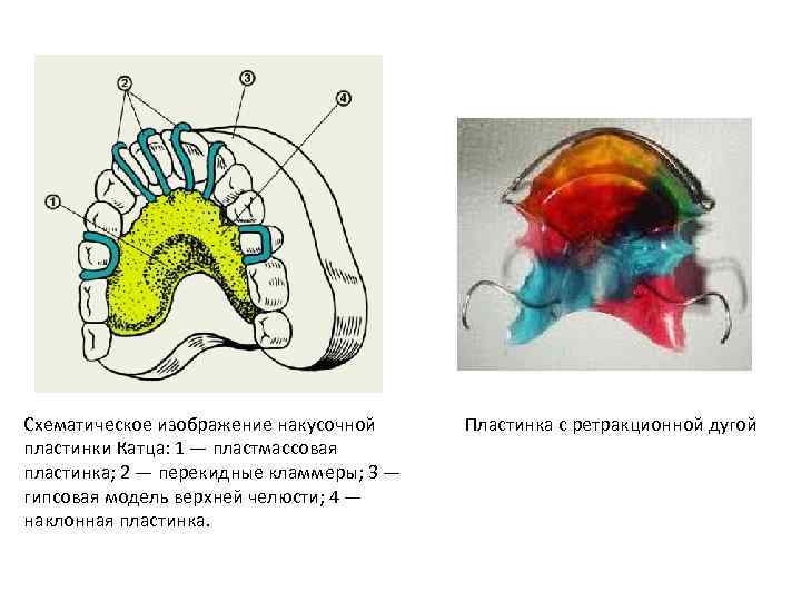 Схематическое изображение накусочной пластинки Катца: 1 — пластмассовая пластинка; 2 — перекидные кламмеры; 3