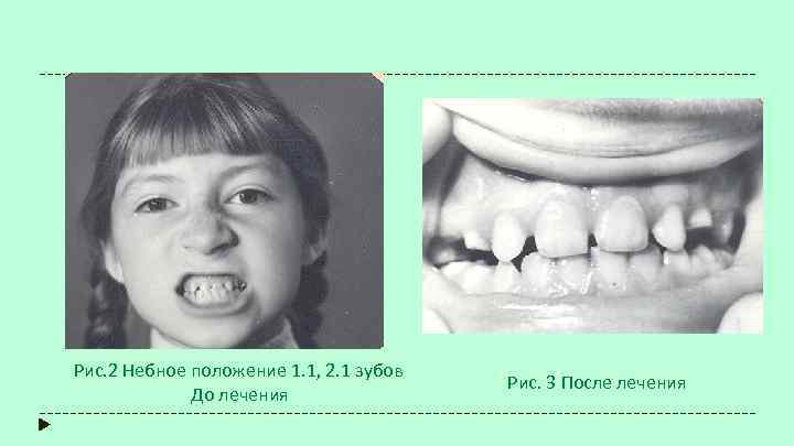 Рис. 2 Небное положение 1. 1, 2. 1 зубов До лечения Рис. 3 После