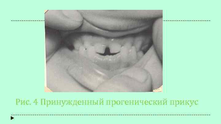 Рис. 4 Принужденный прогенический прикус 