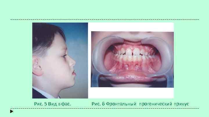 Рис. 5 Вид в фас. Рис. 6 Фронтальный прогенический прикус 