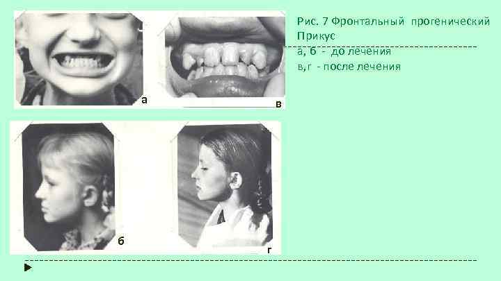 Рис. 7 Фронтальный прогенический Прикус а, б - до лечения в, г - после
