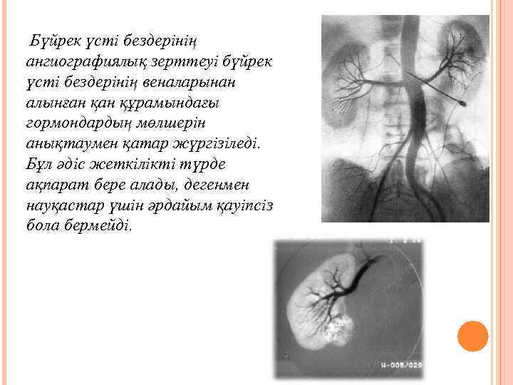 Бүйрек үсті безі аурулары презентация