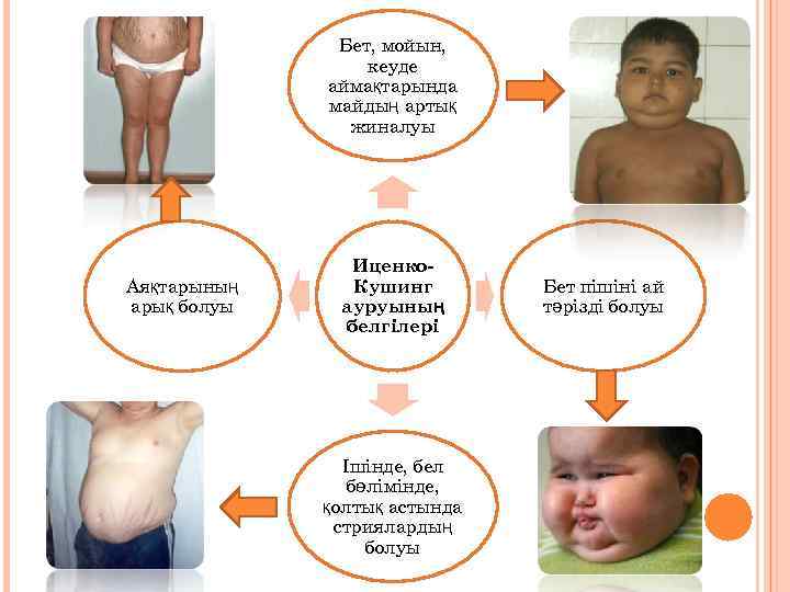 Бет, мойын, кеуде аймақтарында майдың артық жиналуы Аяқтарының арық болуы Иценко. Кушинг ауруының белгілері