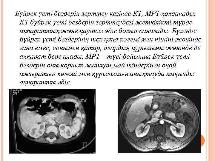 Бүйрек үсті бездерін зерттеу кезінде КТ, MPT қолданады. KT бүйрек үсті бездерін зерттеудегі жеткілікті