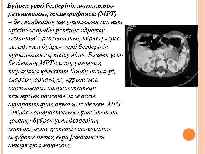  Бүйрек үсті бездерінің магниттікрезонанстық томографиясы (МРТ) – без тіндерінің индуцирленген магнит өрісіне жауабы