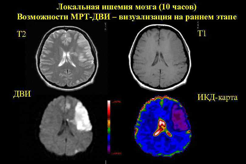 На т2 взвешенных изображениях при нативной магнитно резонансной томографии хорошо визуализируются