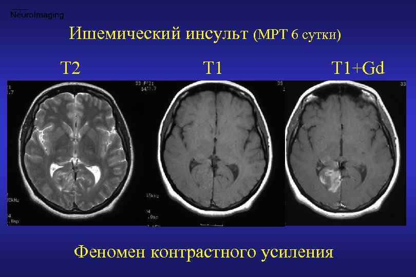 Ишемия мозга мрт. Мрт ишемический инсульт т1. Геморрагический инсульт и ишемический инсульт кт. Геморрагический инсульт головного мозга кт. Ишемический инсульт мозжечка кт.