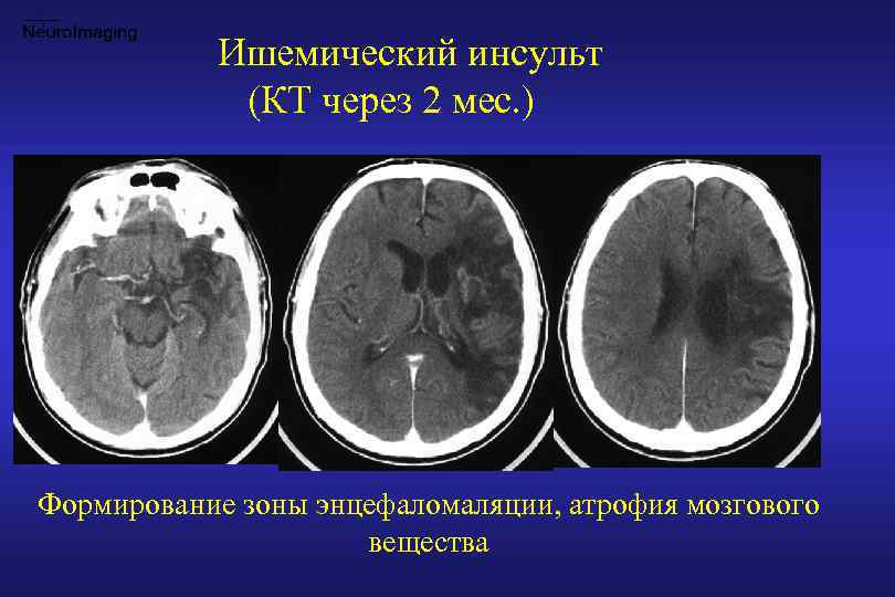 Ишемический инсульт фото мозга