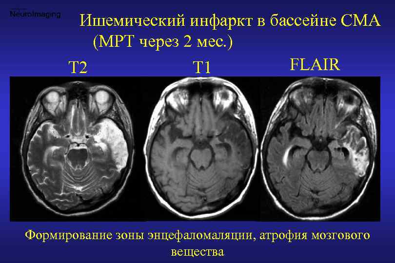 Острый ишемический инсульт клиническая картина