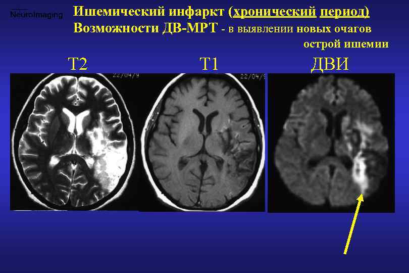 Очаг ишемии головного мозга. Подострый ишемический инфаркт в теменной области. Подростковый ишемический инфаркт подкорных ядер справа.