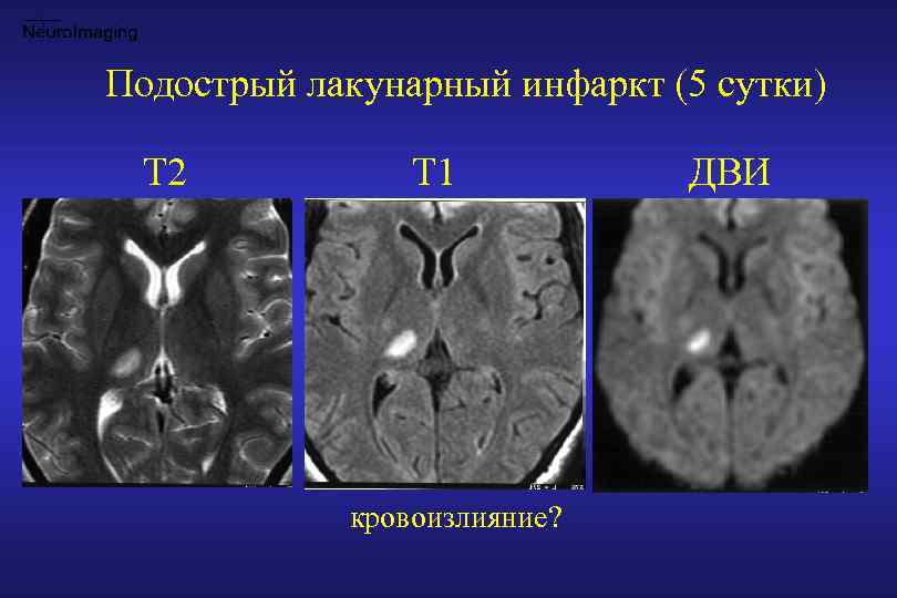 Есть инфаркт мозга